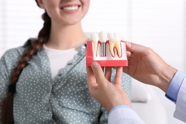 Simple Steps To Place Dental Implants